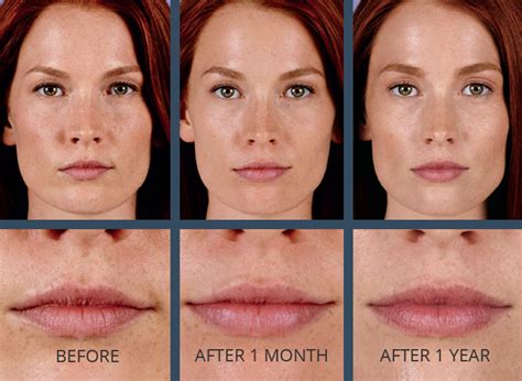 juvederm yucca valley  Presently, there are no Clinics in our network offering Injectable Dermal Fillers in Yucca Valley